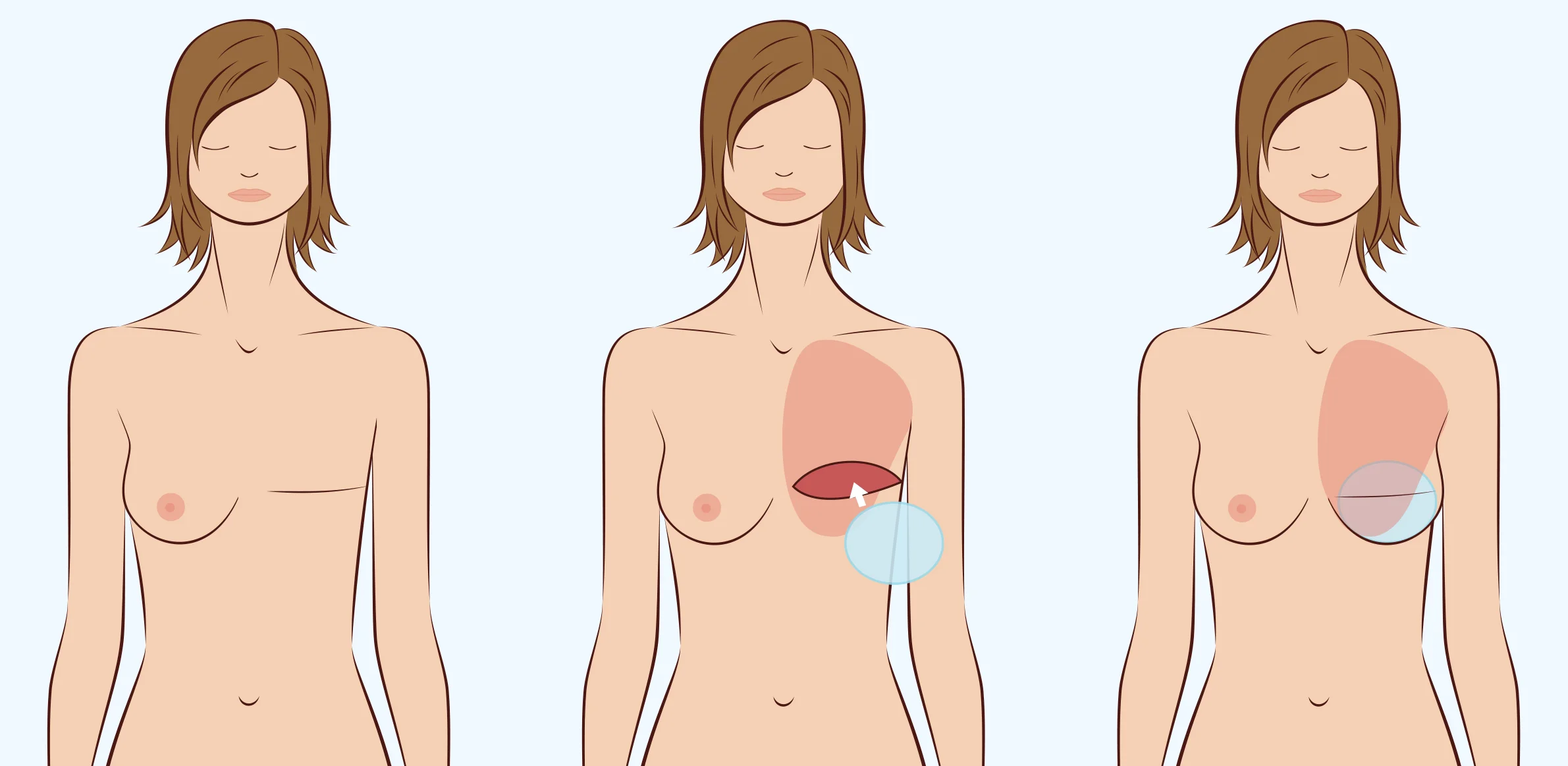 Illustration of implant based breast reconstruction.