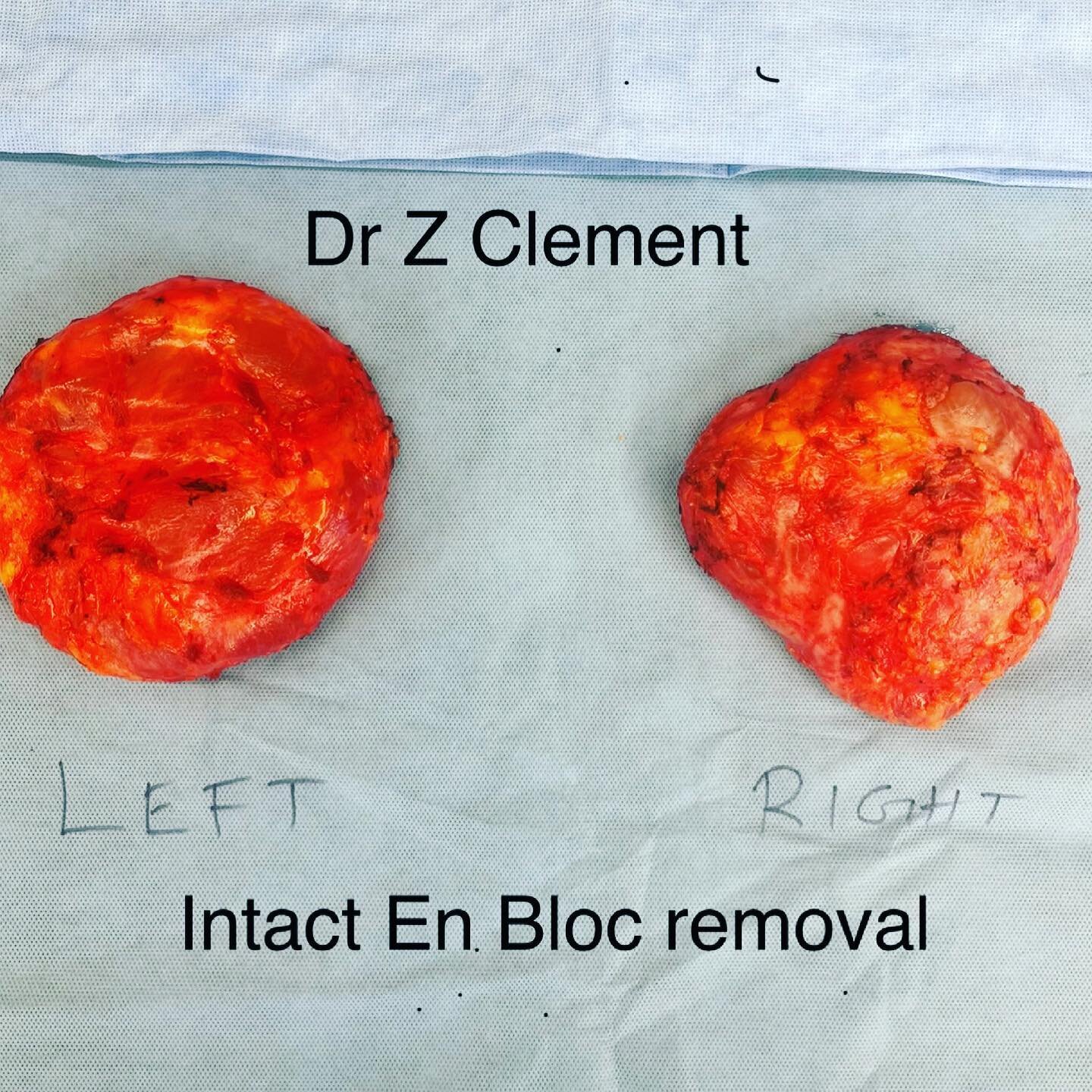 Breast pain! 
13 yo implants torn with implant shell freely floating in the silicone. Intact en bloc removal! 

#breastimplants #rupturedbreastimplants #breastpain #inflammation #capsularcontracture #enbloc #enblocexplant #explantsurgery #breastlift 