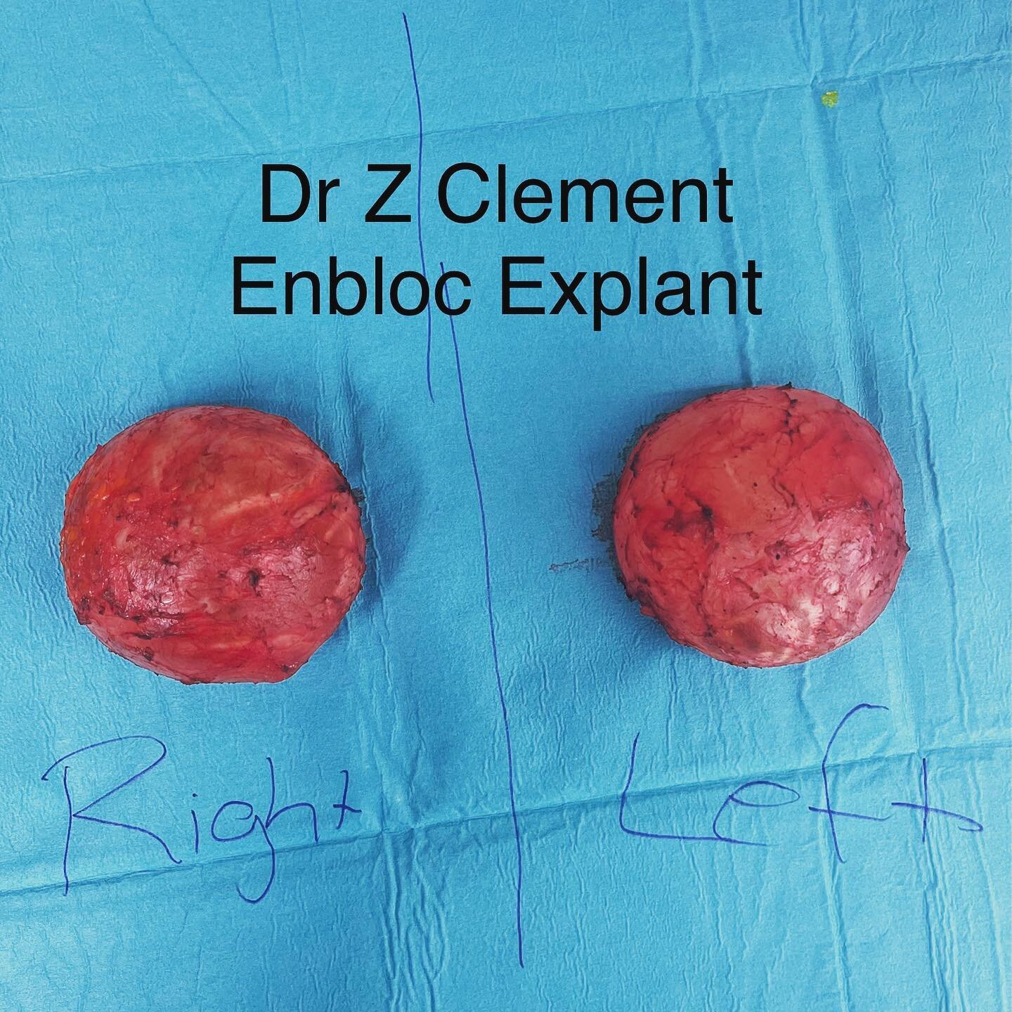 Enbloc explant takes time! It requires careful meticulous dissection saving your natural breast tissue and remove absolutely only the scar tissue! 

#breastimplants #explant #rupturedbreastimplants #explantsurgery #enbloccapsulectomy #breastimplantre