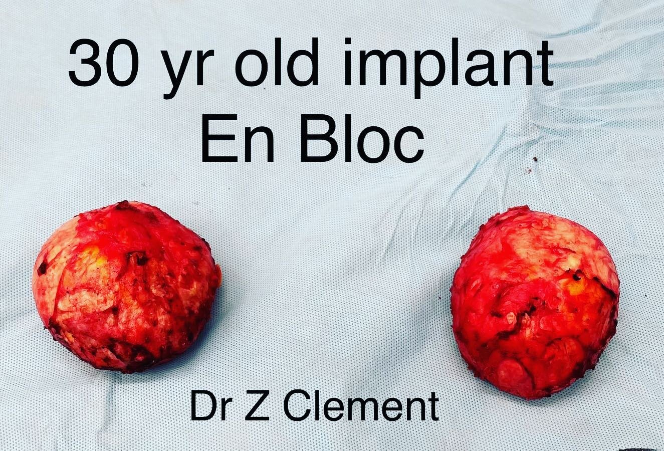 30 year old rock hard calcified ruptured implants! 
Get your implants checked.. they are not life time devices!

#breastimplant #rupturedbreastimplants #capsularcontracture #enbloc #enbloccapsulecotmy #explant #breasthealth #explantsurgery #getyourim