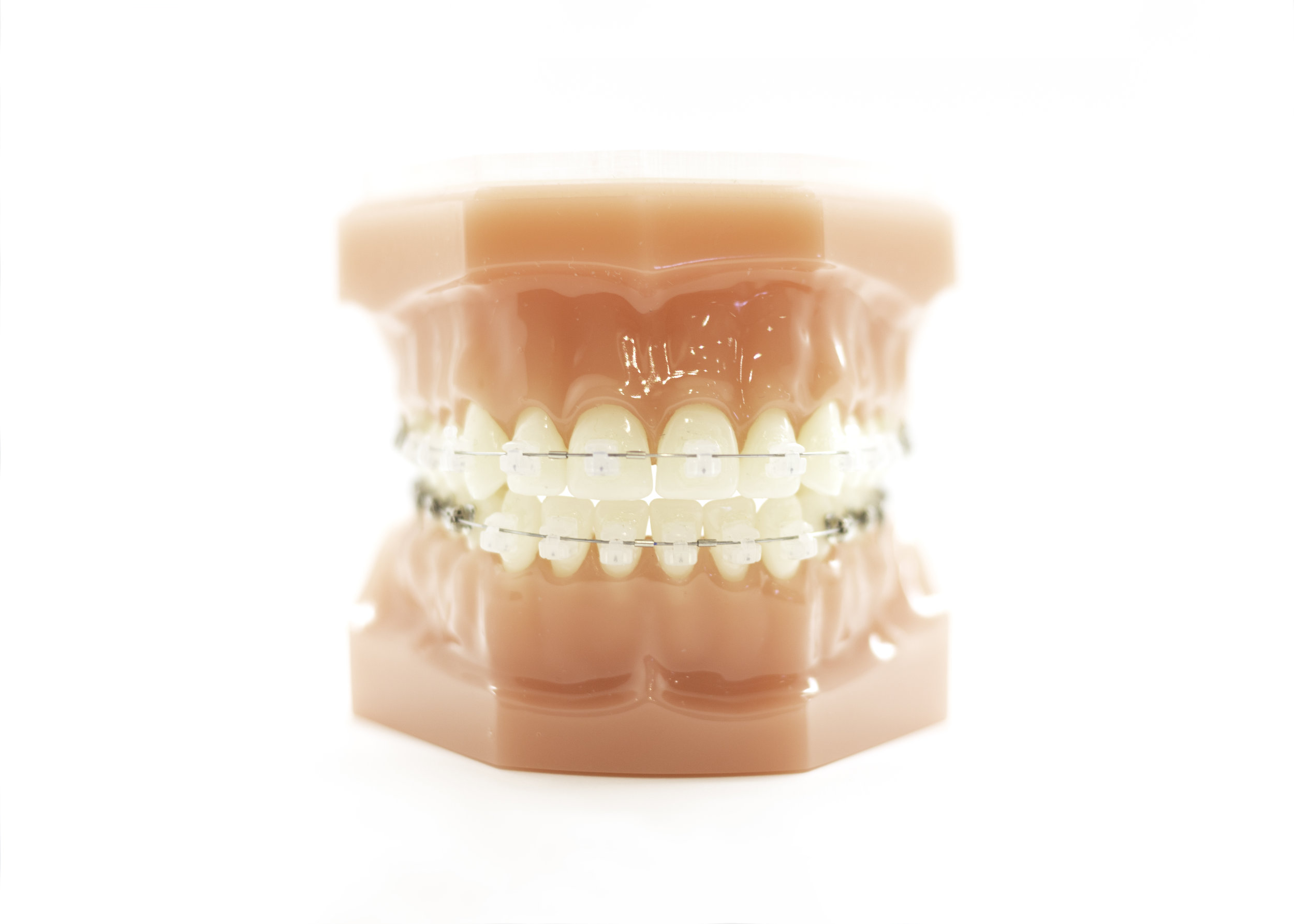 Damon Braces | Damon Clear