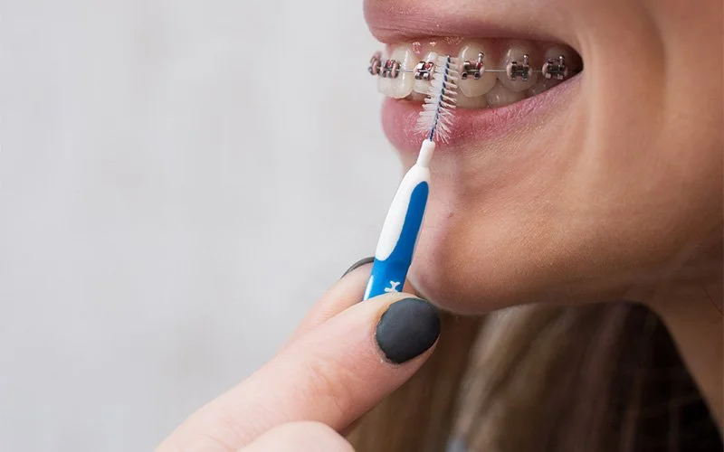 Close‑up of braces cleaned with interdental brush.