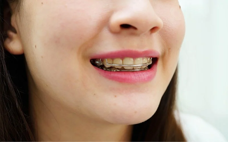 Close-up of mouth wearing clear dental retainer.
