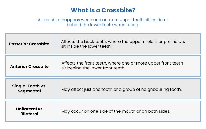 Dental chart explaining types of crossbite.