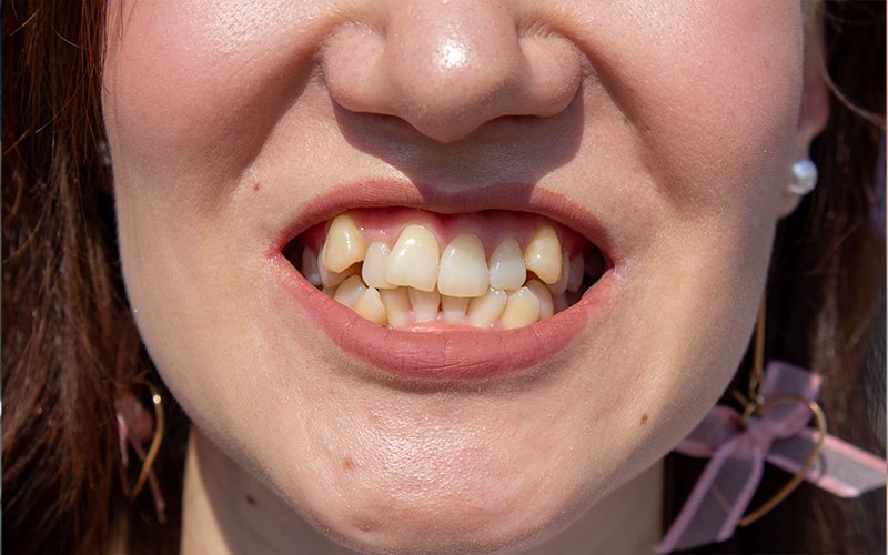 a woman with Malocclusion