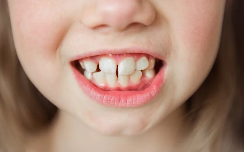Child’s mouth showing mixed dentition with baby and adult teeth..jpg