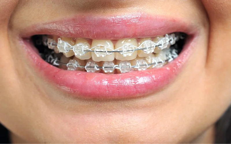 Close-up of teeth with ceramic braces.