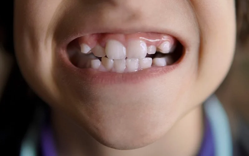 Child with crowded teeth needing palatal expander orthodontic treatment.