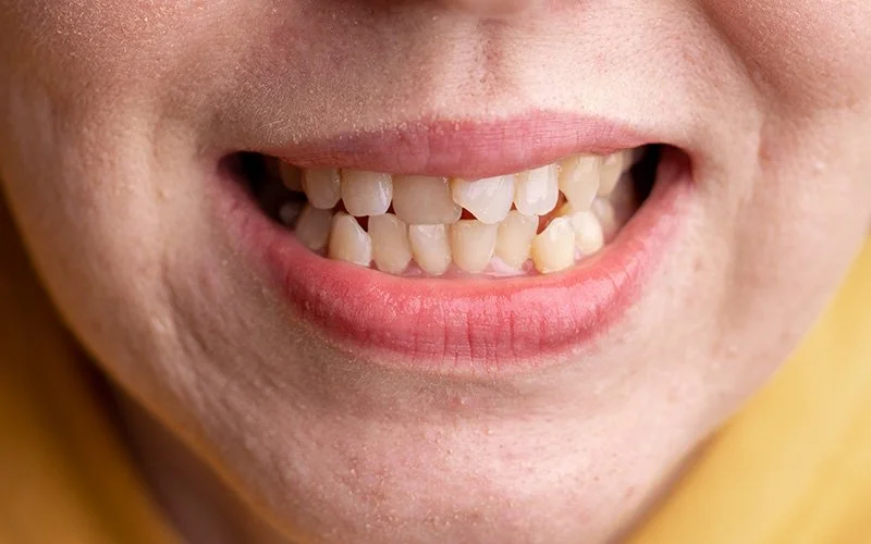 Close up of misaligned lower and upper teeth bite.
