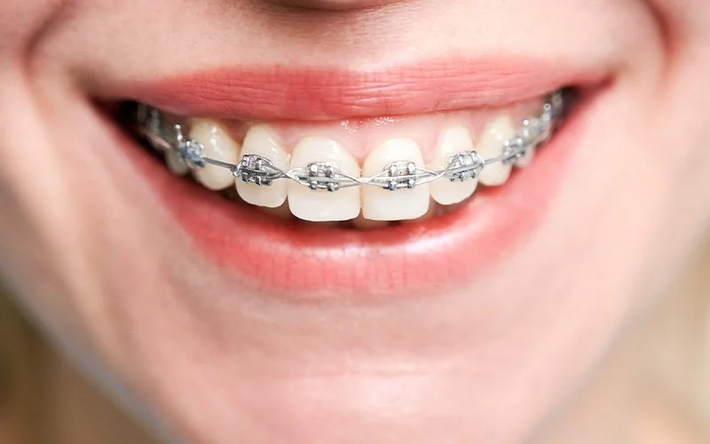 Patient wearing metal braces to correct teeth alignment and spacing.
