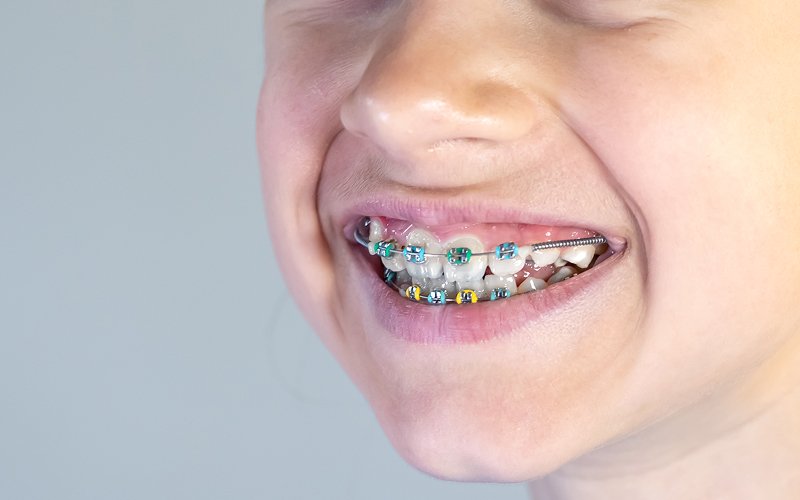 Child showing dental braces and palate expansion orthodontic appliance.