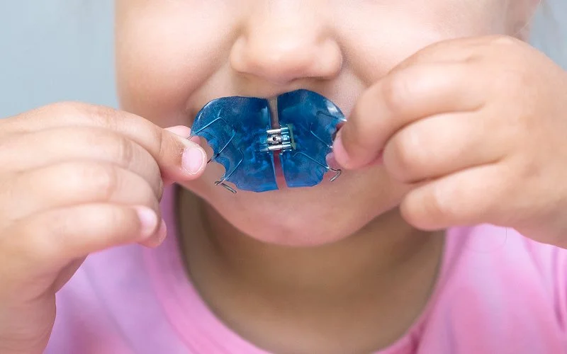 Child placing a blue removable palatal expander into mouth.