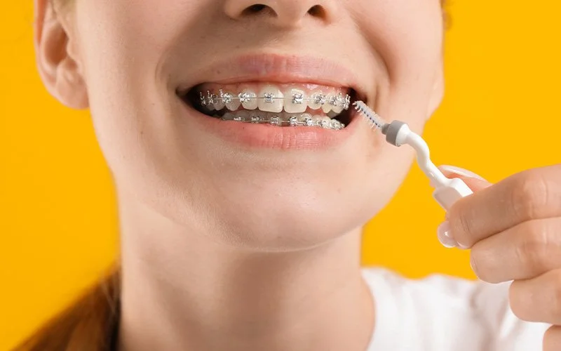 Person cleaning metal dental braces with an interdental brush.
