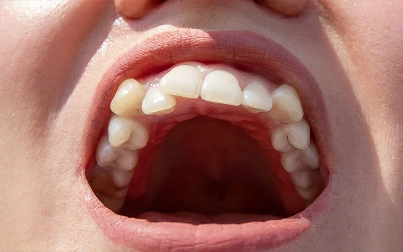 a smile with Malocclusion and crooked teeth