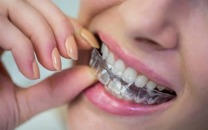 Patient wearing a clear plastic retainer to prevent teeth shifting.