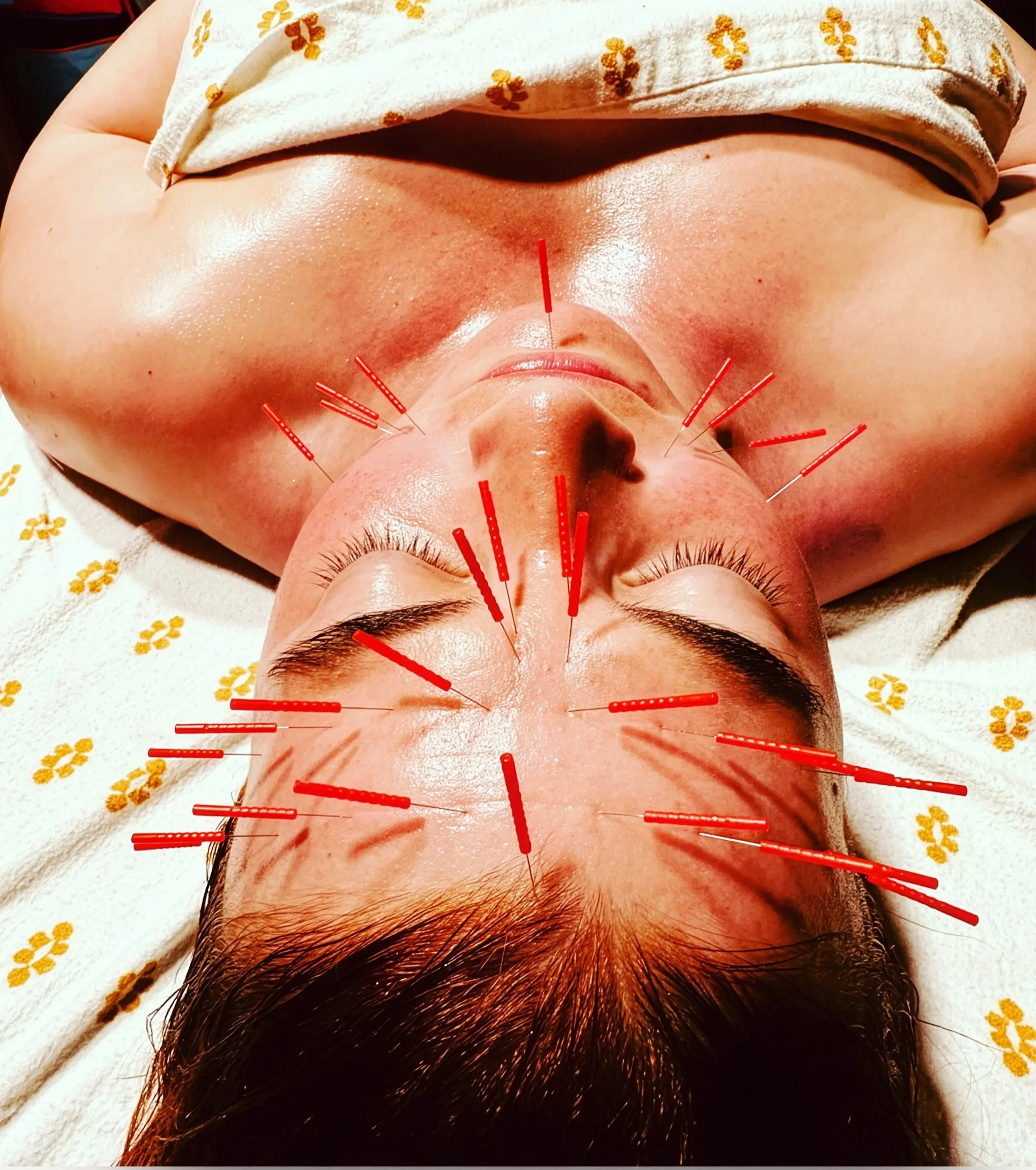A person lying down with eyes closed, receiving acupuncture with multiple red needles inserted into their face, forehead, and neck.