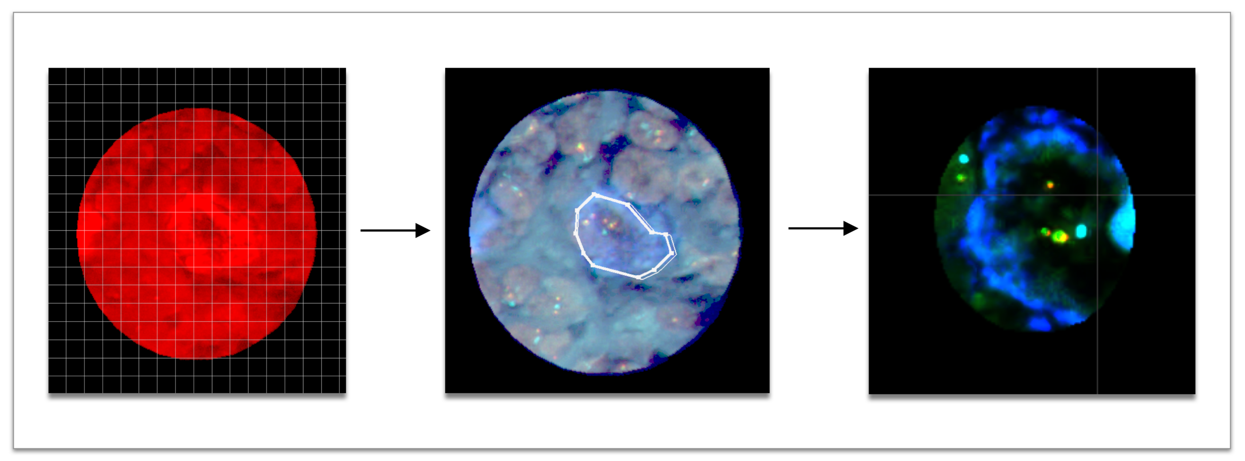 The uploaded cell images show the outlines of a cancer cell nucleus, and pathologists select desired nuclei for analysis, meaning Imaris quantifies the spots and fusion in the selected nuclei.