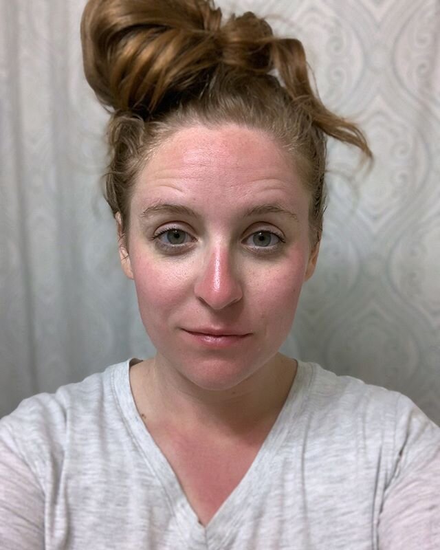 Lets talk about sunburns. ⠀⠀⠀⠀⠀⠀⠀⠀⠀
⠀⠀⠀⠀⠀⠀⠀⠀⠀
This is the face of a dummy who didn&rsquo;t apply sunscreen and then spent an entire day outside. 🤦🏼&zwj;♀️ My face still hurts two days later. ⠀⠀⠀⠀⠀⠀⠀⠀⠀
⠀⠀⠀⠀⠀⠀⠀⠀⠀
We all know that the sun can burn our