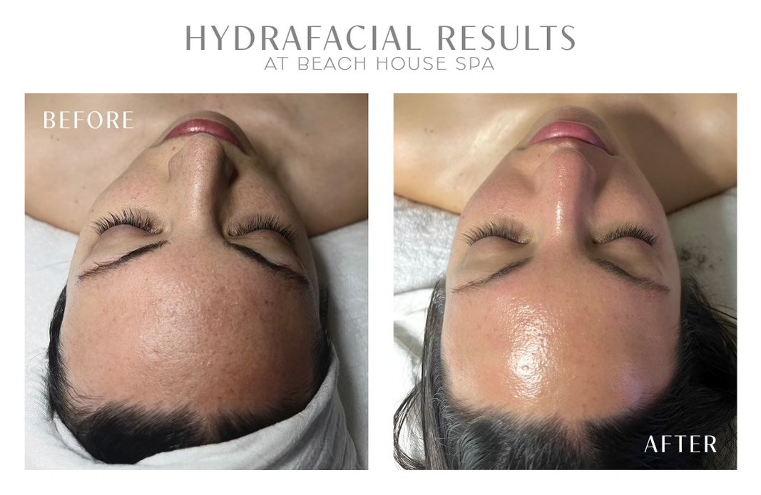 hydrafacial.jpg