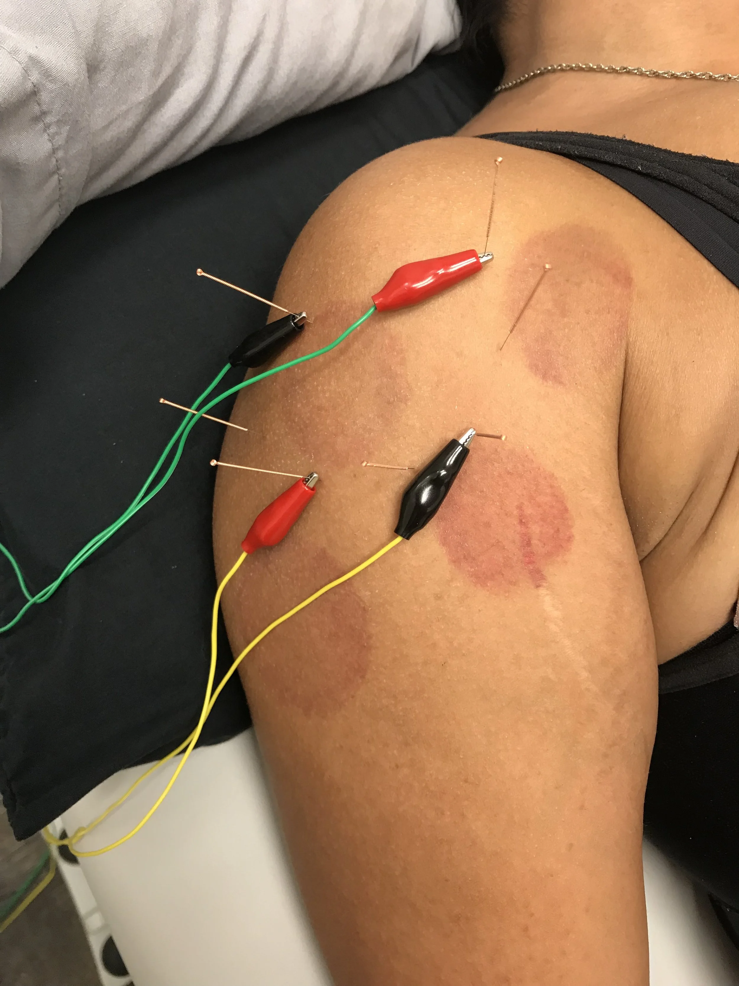 This patient received acupuncture with elecro-stimulation and bruising from cupping performed the previous day to help relieve shoulder pain