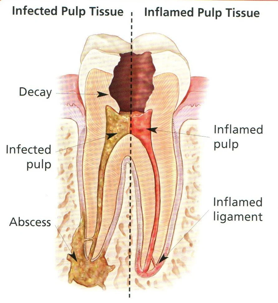 What Is Endodontics? — soquel endodontics