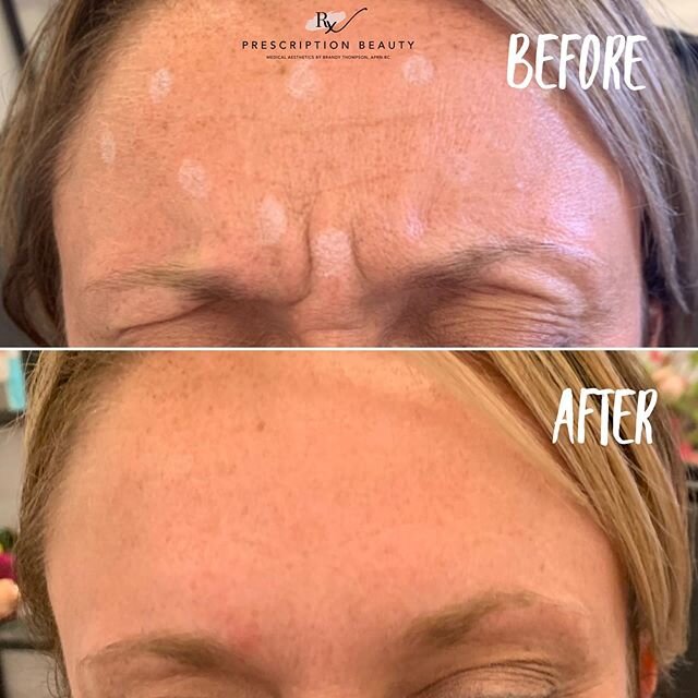 💉 BOTOX 💉⁣
⁣
Not only does Botox treat tension headaches, muscle strain, and TMJ but it also smooths those pesky wrinkles that make us age faster. 💕⁣
⁣
For this client we treated the area between the brows known as the &ldquo;mad face.&rdquo; We a