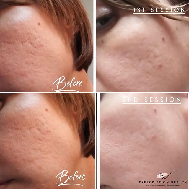 👩🏼&zwj;⚕️ACNE SCARRING  TREATMENT👩🏼&zwj;⚕️⁣
⁣
One of the number one treatments that gives results EVERY SINGLE time is Microneedling. 😍⁣
⁣
This client has suffered with acne scarring for years. After her initial consultation we decided on a leve