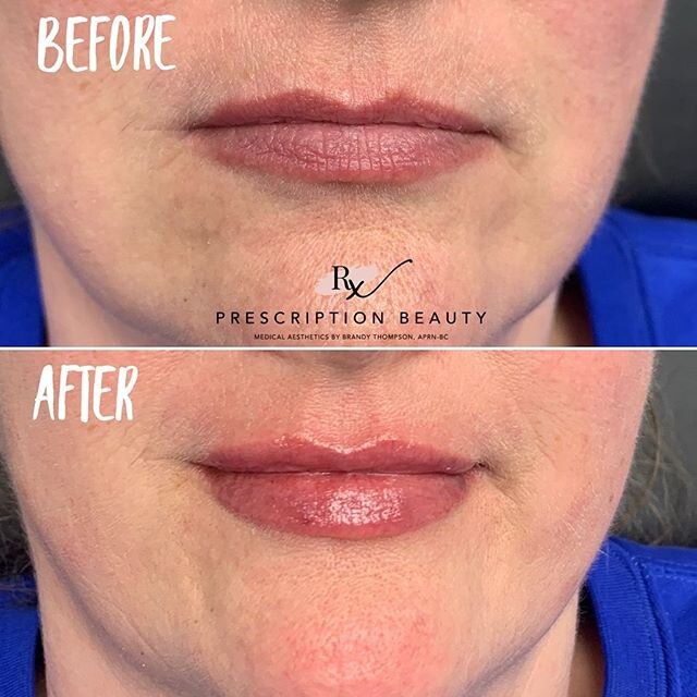 💋Natural Lip Enhancements💋⁣
⁣
You should never look like you have had &ldquo;work&rdquo; done. 💉⁣
⁣
I love that I get to work one on one with you to create a plan that is best for you. 😍⁣
⁣
My number one goal is always natural results that leaves