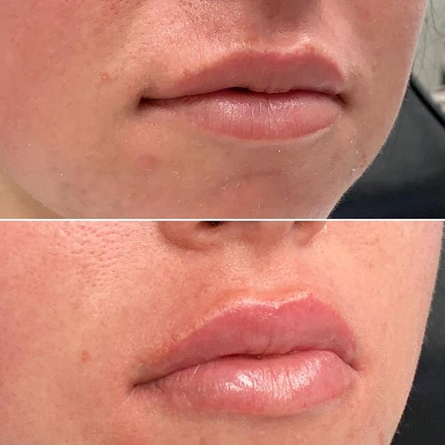 Creating the perfect lips one session at a time. 💋

This beauty had her touch up session and we added an additional half syringe of Juvaderm Ultra XC for more volume and definition. 😍

#lips #one #prescriptionbeautymedaesthetics #volume #beauty #de