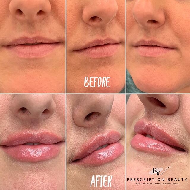 💋 Transformation  Thursday!💋
⁣
I&rsquo;ve been working with this gorgeous girl for almost a year now on her luscious lip journey. 👄⁣
⁣
Using a half syringe of Volbella and a full syringe of Juvaderm Ultra Plus XC over 4 sessions. 💉⁣
⁣
Lip flips w