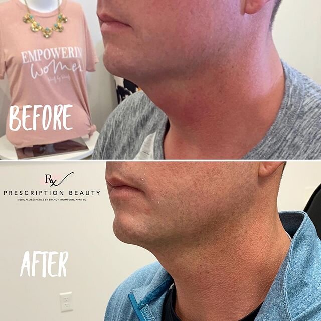 💉 KYBELLA 💉⁣
⁣
Only 8 weeks post Kybella injections for the double chin area. 💕⁣
⁣
These results at his follow up are amazing! Kybella melts away fat cells PERMANENTLY!😍⁣
⁣
Full results are seen 4-6 months after injections as the skin starts to t