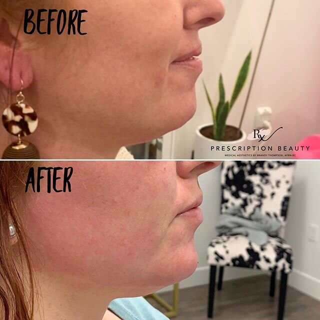 ❤️ This beauty wanted a stronger, enhanced chin for profile balancing and that&rsquo;s just what she got. ❤️⁣
⁣
Subtle enhancements can help balance our facial features and enhance our profile. 💉⁣
⁣
It isn&rsquo;t always about lips guys. It&rsquo;s 