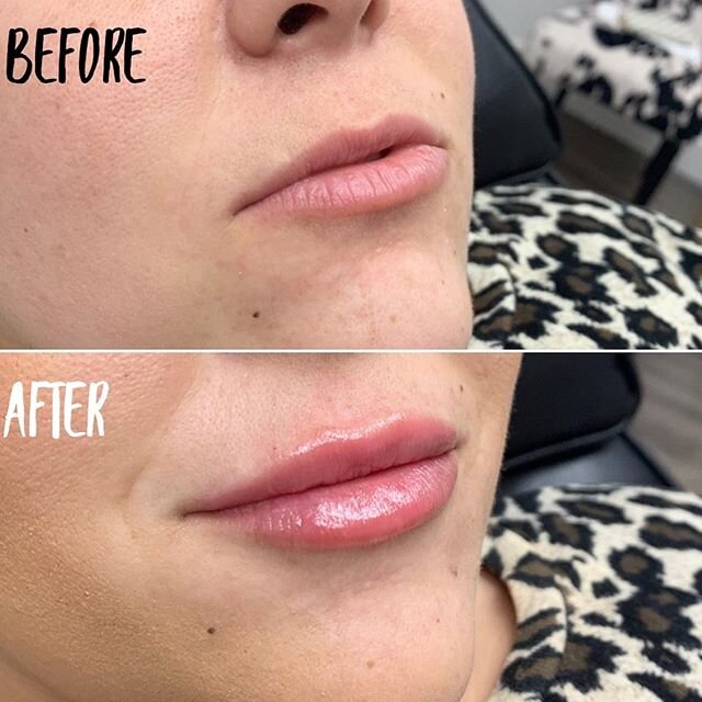 👄2020 is the year of LIPS 👄 ⁣
⁣
If you have been contemplating lip filler now is the time to get your dream lips. 💋⁣
⁣
It is my favorite aesthetic injectable procedure as it enhances all of your beautiful facial features. ❤️⁣
⁣
I am OCD when it co