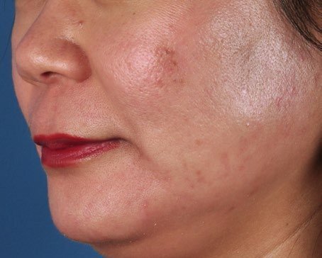 zo skin benzoyl peroxide