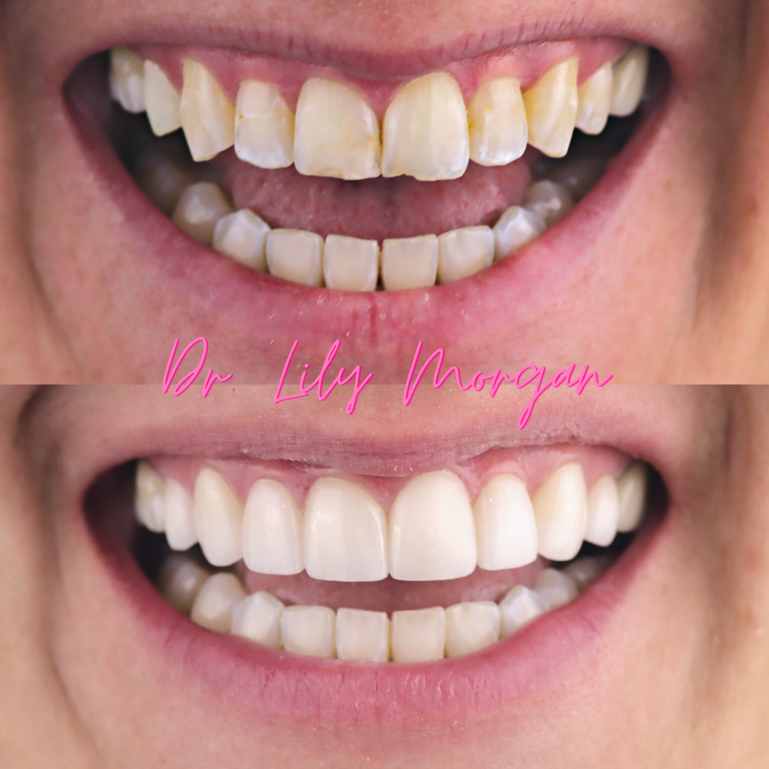 Veneers ad Crowns