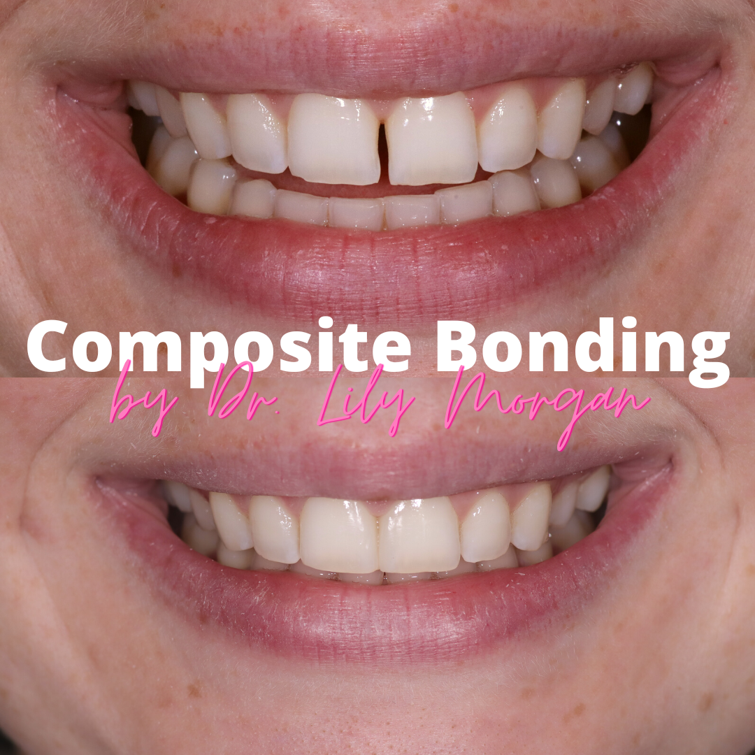 Composite bonding