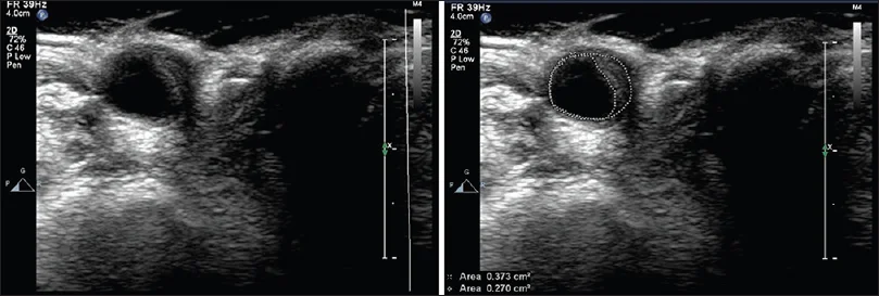 JIndianAcadEchocardiogrCardiovascImaging_2017_1_1_39_204070_f4.jpg