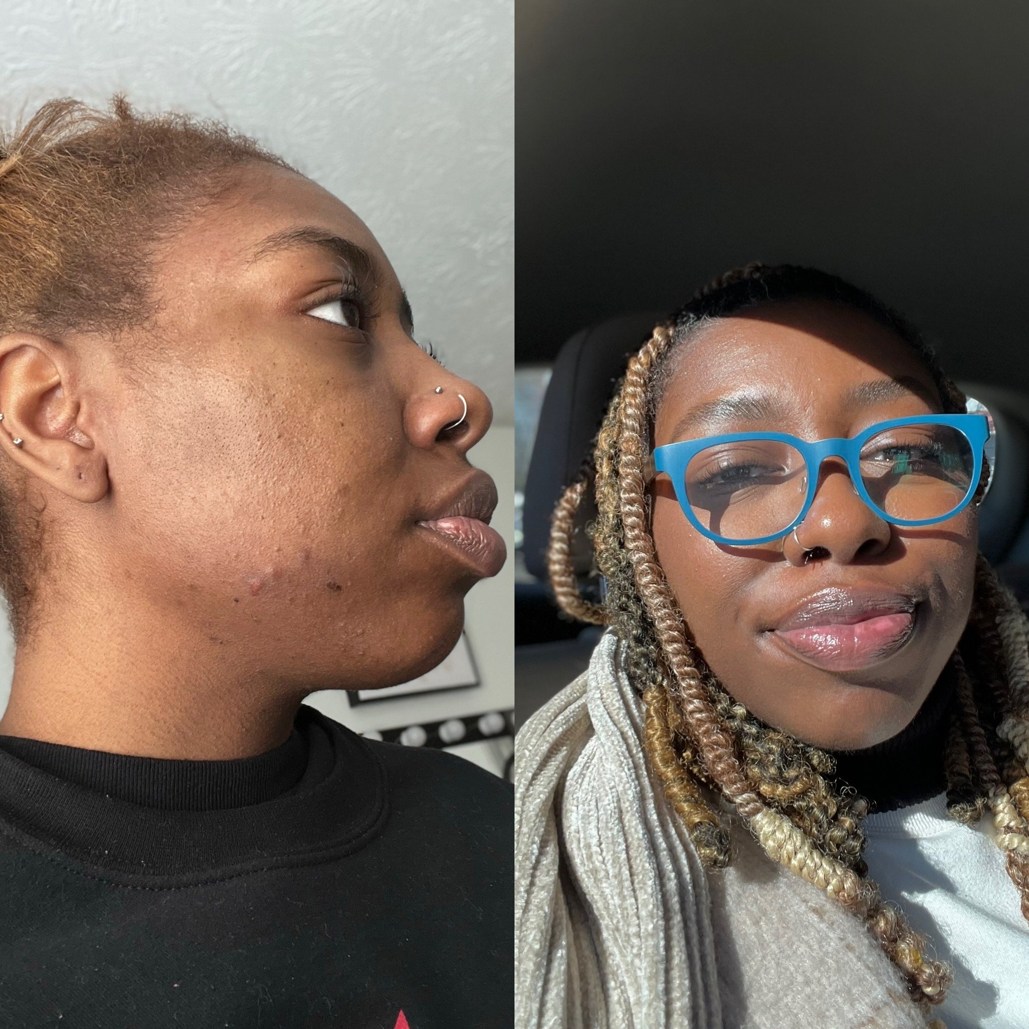 #1 Way to Clearer Skin!