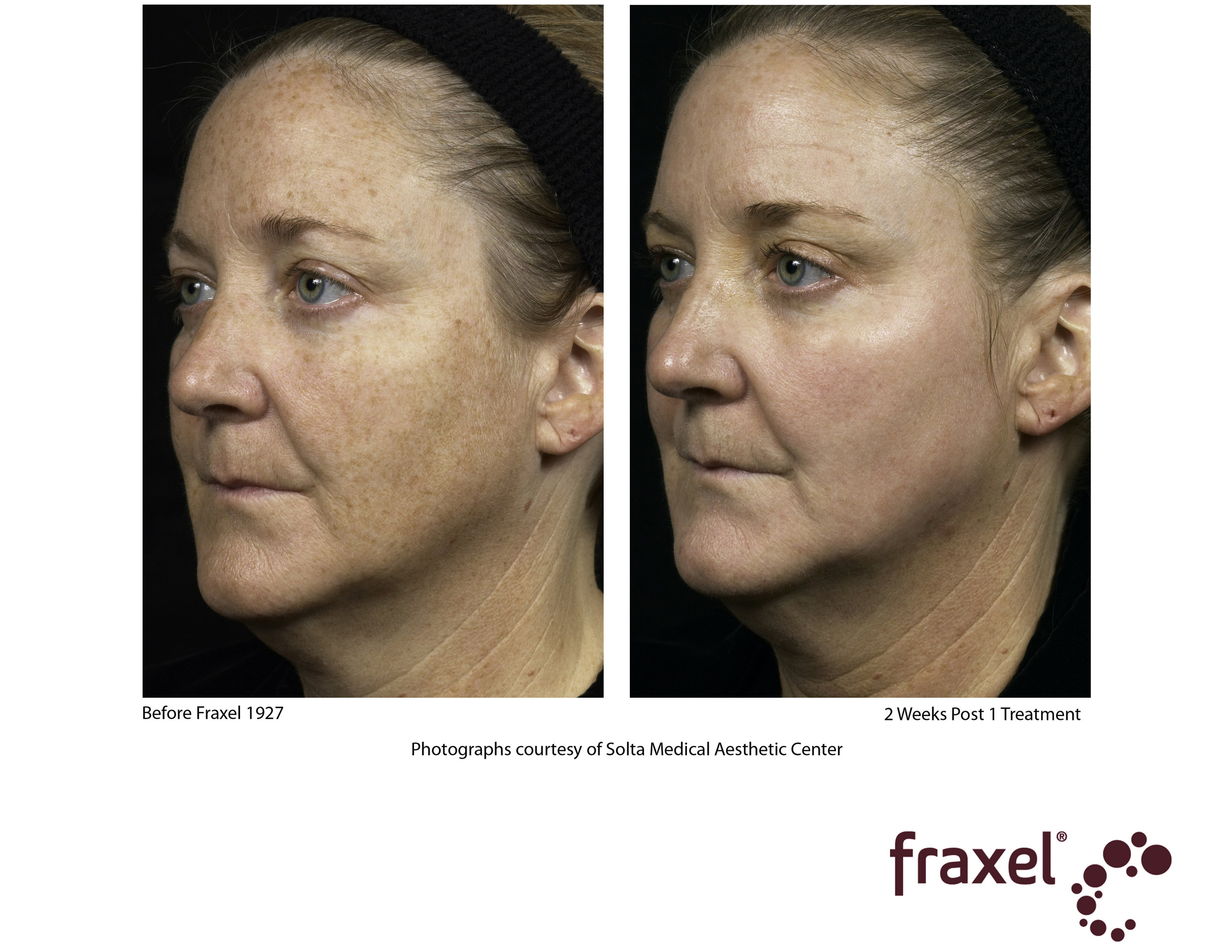 0280-Fraxel_1927_2_HiRes.jpg