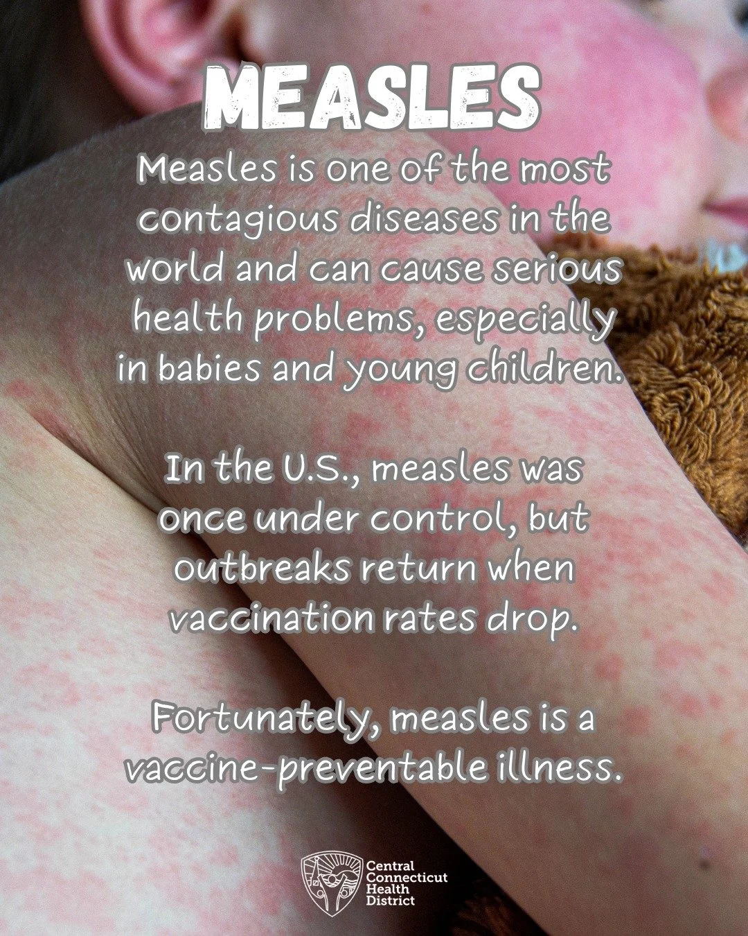 Do you have questions about measles? Take a look, and then go to healthychildren.org (or click the link in our bio) for even more information not only about measles, but about many other childhood diseases and concerns. #measles #childhoodillness #va