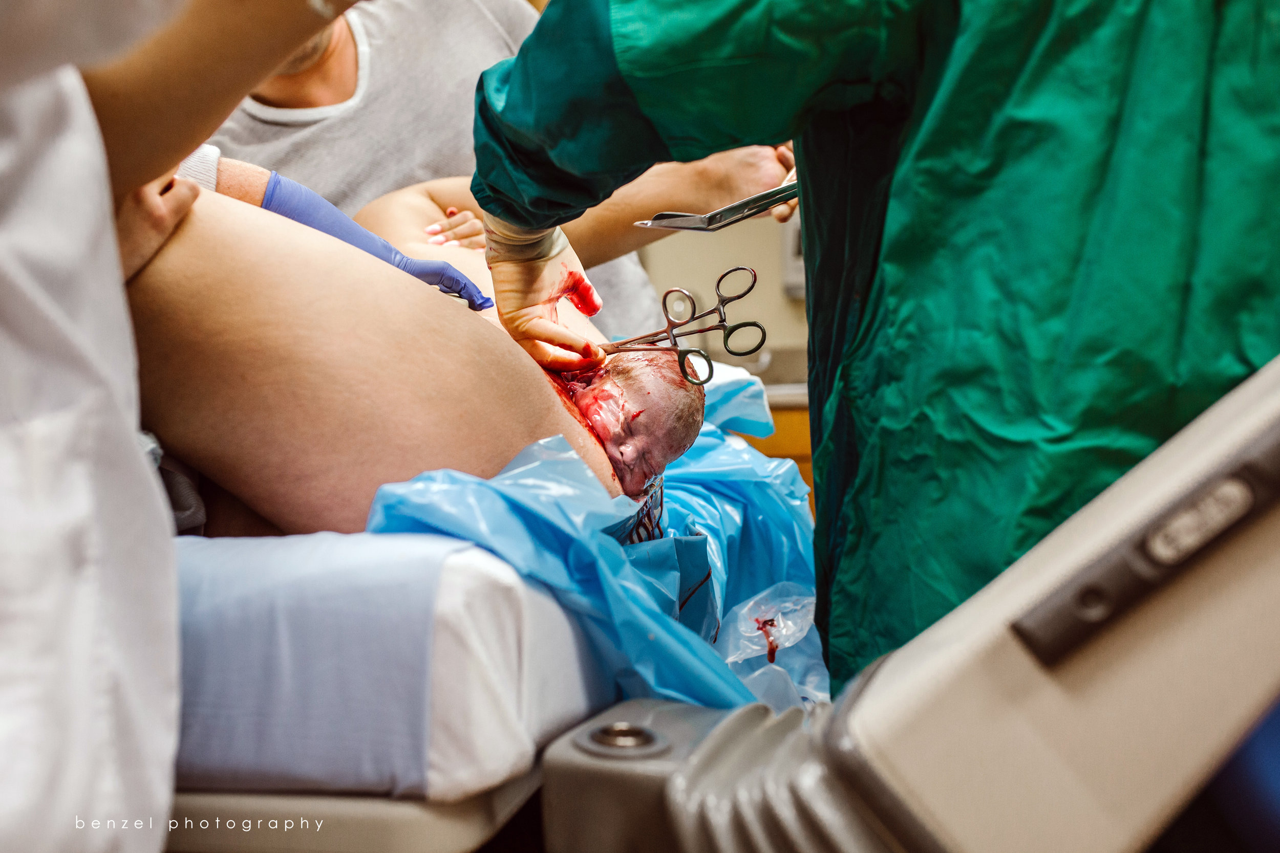 Nuchal Cord(s)