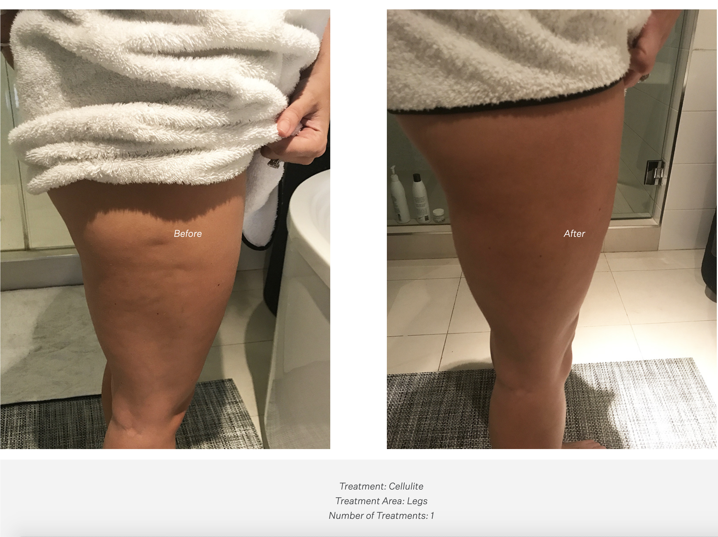 REJUV — Encinitas & Carlsbad CryoSkin CryoSlimming & CryoToning