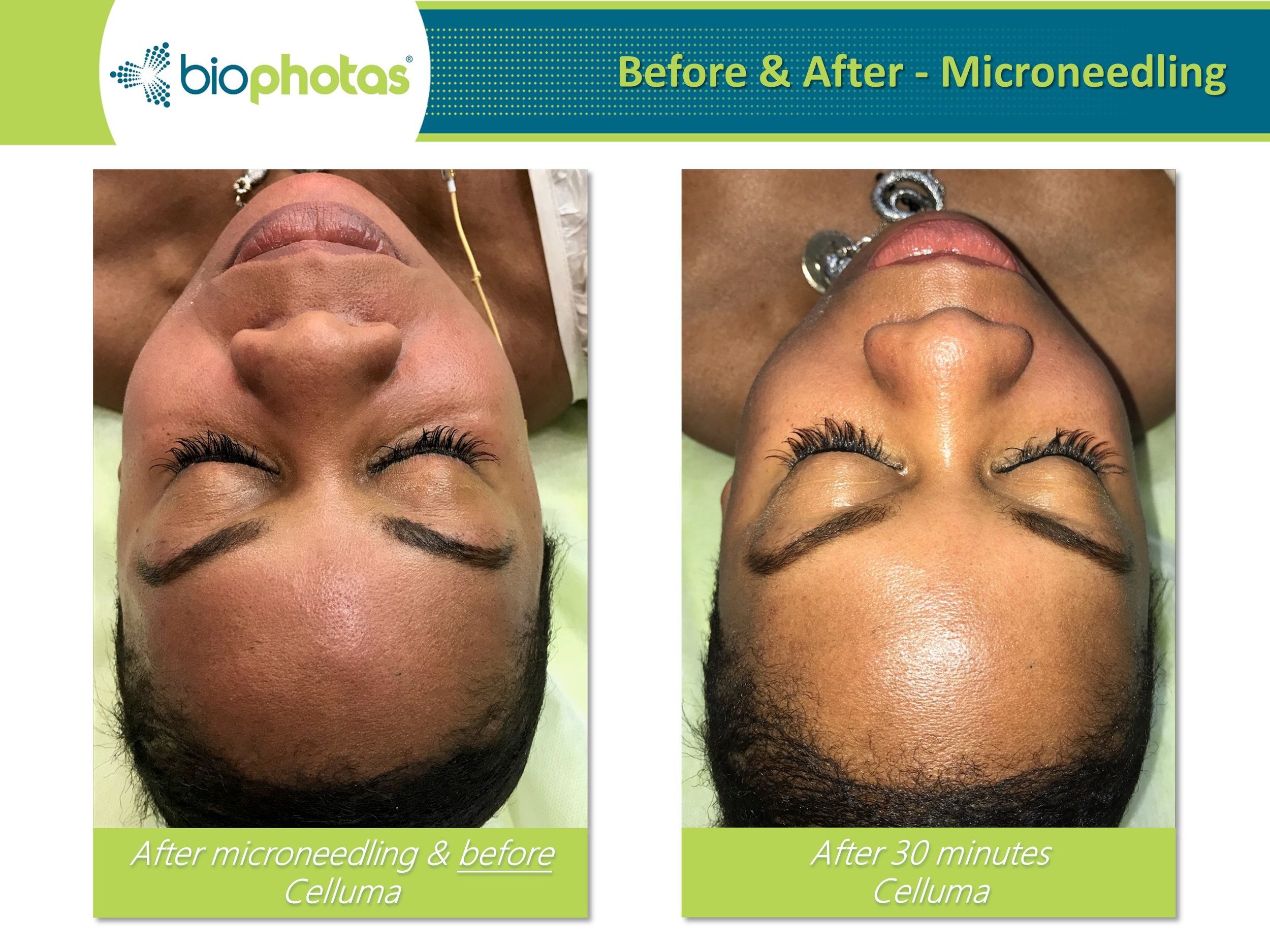 Celluma Facial Light Therapy Encinitas & Carlsbad REJUV