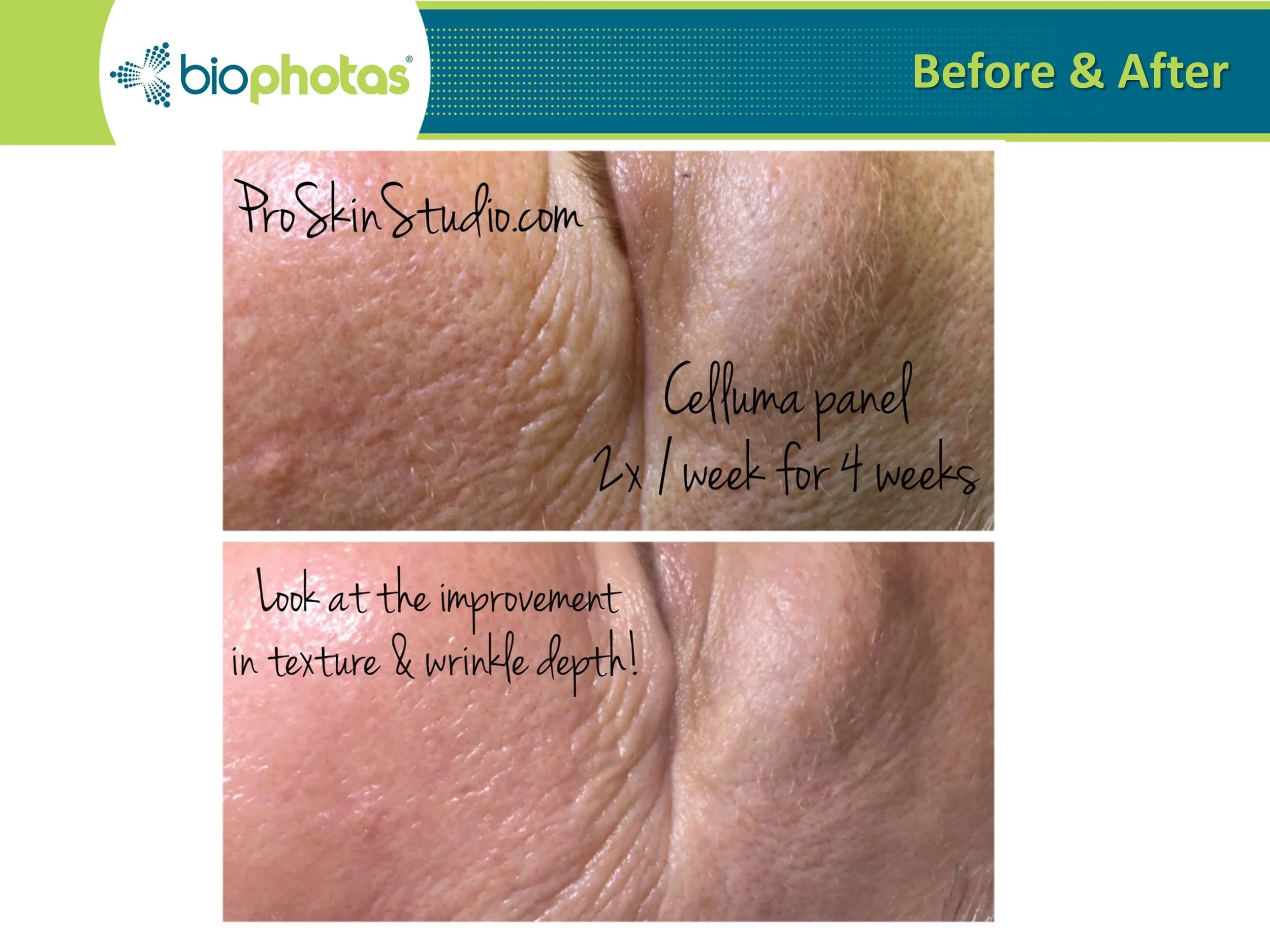 Celluma Facial Light Therapy Encinitas & Carlsbad REJUV