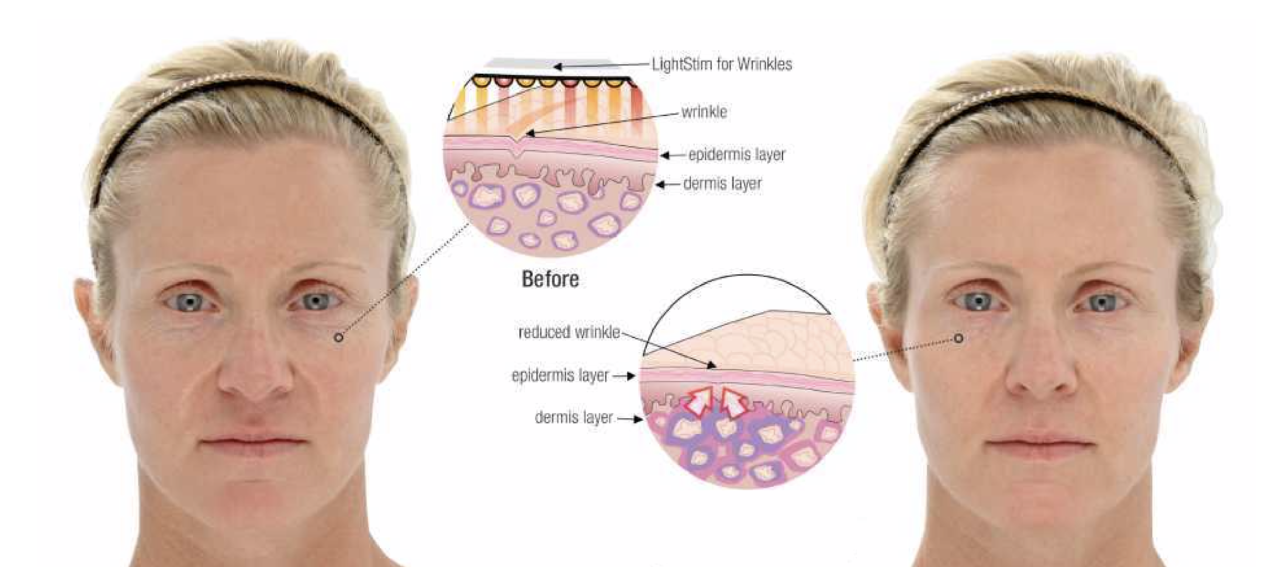 LED LightStim Facial Results RejuvCryo & Wellness.png