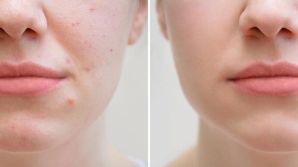 acne-treatment-before-and-after-rejuvcryo-la-costa.jpg