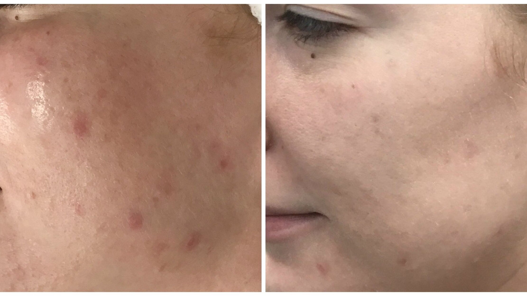 rejuvcryo-acne-carlsbad-encinitas-therapy.jpg