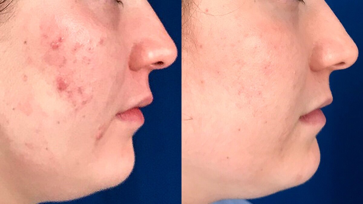 cystic-acne-scare-before-after-rejuvcryo-encinitas-carlsbad.jpg
