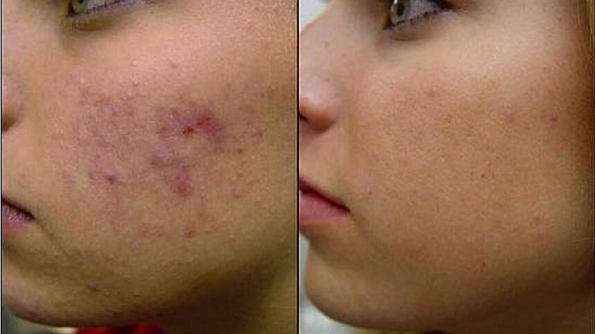 acne-therapy-results-rejuvcryo-carlsbad-encinitas.jpg