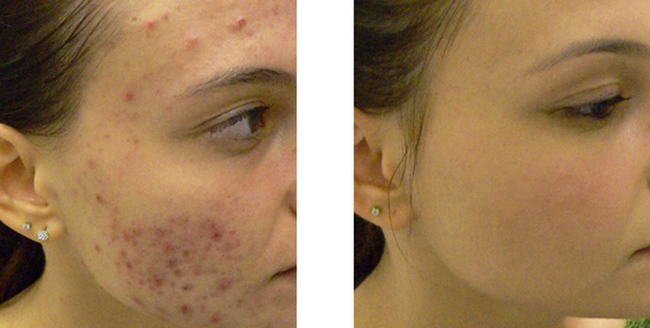 severe-acne-treatment-results-rejuvcryo-encinitas.jpg